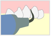 1. 歯石・歯垢除去
